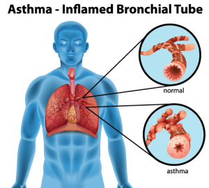 asthma-mold
